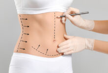 Is a Tummy Tuck Right for You?