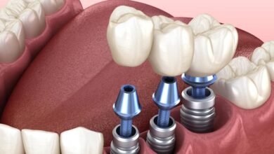Innovations in Dental Implants: What You Need to Know