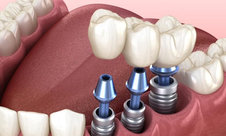 Innovations in Dental Implants: What You Need to Know
